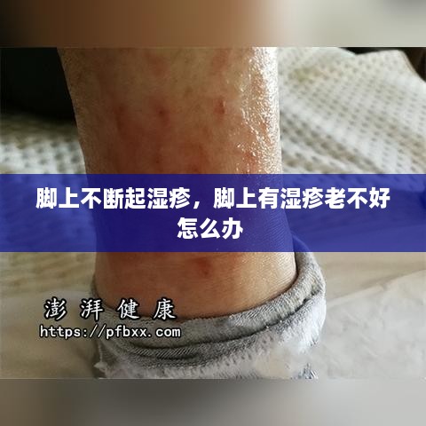 腳上不斷起濕疹，腳上有濕疹老不好怎么辦 